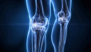 Protesi ginocchio: benefici e tempi di recupero