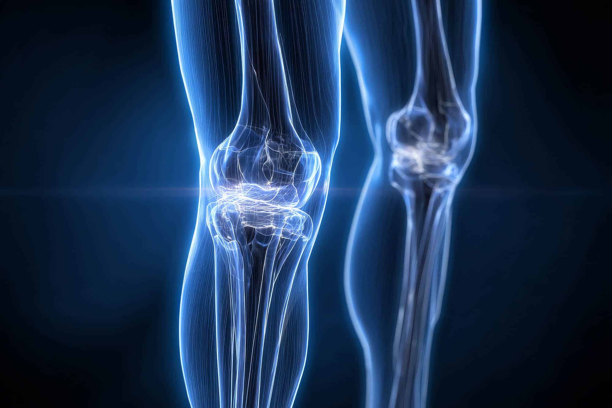 Protesi ginocchio: benefici e tempi di recupero